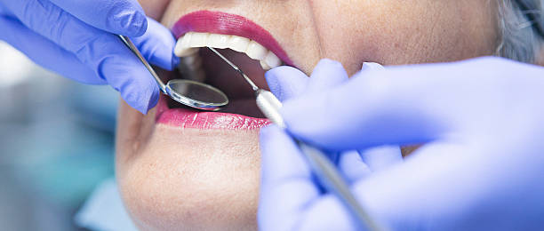 Best Chipped Tooth Repair Near Me  in Bellevue, OH